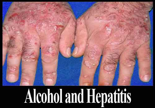 Alcohol & Hepatitis