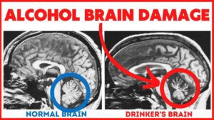 11 Ways Alcohol Induces Brain Damage - Often Irreversible