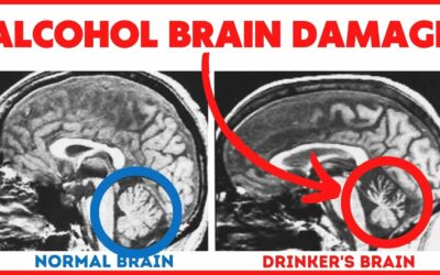 11 Ways Alcohol Induces Brain Damage – Often Irreversible!